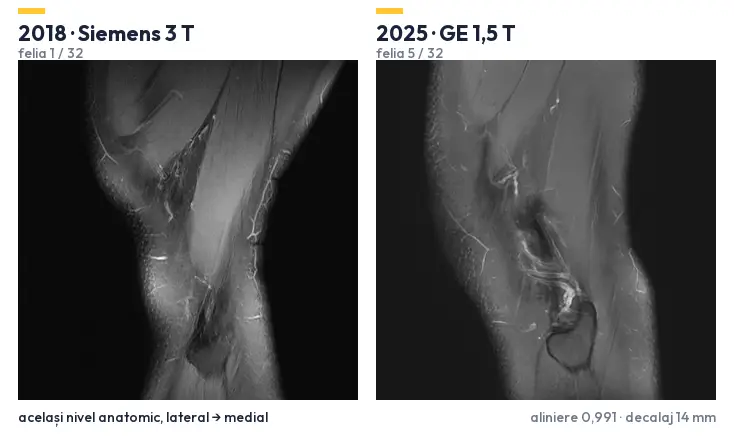 Două examinări RMN ale aceluiași genunchi, din 2018 și 2025, derulate în paralel la aceleași niveluri anatomice, aliniate din geometria DICOM